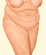 body contouring body lift