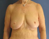 Breast Lift Before Photo by Neal Goldberg, MD; Scarsdale, NY - Case 10173