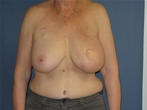Breast Reconstruction After Photo by Neal Goldberg, MD; Scarsdale, NY - Case 21328