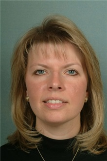 Eyelid Surgery After Photo by Robert Zubowski, MD; Paramus, NJ - Case 23717