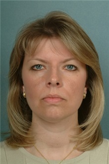 Eyelid Surgery Before Photo by Robert Zubowski, MD; Paramus, NJ - Case 23717