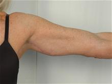 Arm Lift After Photo by R. Scott Yarish, MD; Houston, TX - Case 27622