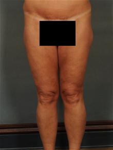 Body Contouring After Photo by Ellen Janetzke, MD; Bloomfield Hills, MI - Case 28676