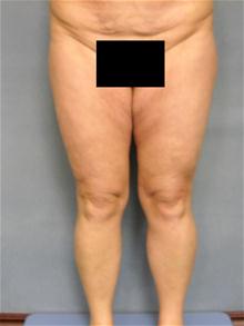 Body Contouring Before Photo by Ellen Janetzke, MD; Bloomfield Hills, MI - Case 28676