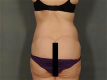 Body Lift After Photo by Ellen Janetzke, MD; Bloomfield Hills, MI - Case 29424