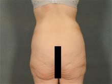 Body Lift Before Photo by Ellen Janetzke, MD; Bloomfield Hills, MI - Case 29424