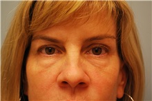 Eyelid Surgery Before Photo by Kristoffer Ning Chang, MD; San Francisco, CA - Case 29768