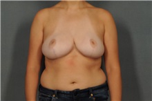 Breast Reduction After Photo by Ellen Janetzke, MD; Bloomfield Hills, MI - Case 30467
