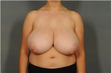 Breast Reduction Before Photo by Ellen Janetzke, MD; Bloomfield Hills, MI - Case 30467