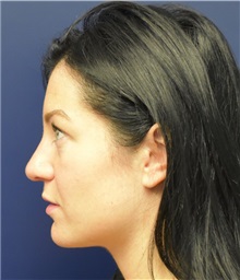 Rhinoplasty After Photo by Richard Reish, MD, FACS; New York, NY - Case 30555