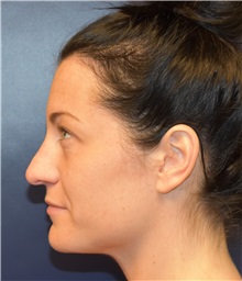 Rhinoplasty Before Photo by Richard Reish, MD, FACS; New York, NY - Case 30555