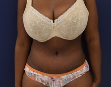 Tummy Tuck After Photo by Richard Reish, MD, FACS; New York, NY - Case 30559