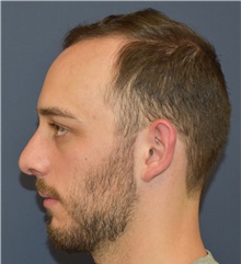 Rhinoplasty After Photo by Richard Reish, MD, FACS; New York, NY - Case 30560