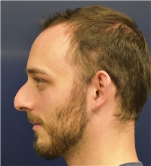 Rhinoplasty Before Photo by Richard Reish, MD, FACS; New York, NY - Case 30560