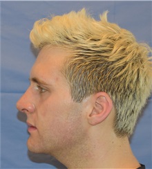 Rhinoplasty After Photo by Richard Reish, MD, FACS; New York, NY - Case 30565