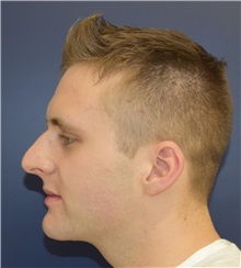 Rhinoplasty Before Photo by Richard Reish, MD, FACS; New York, NY - Case 30565