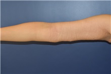 Arm Lift After Photo by Richard Reish, MD, FACS; New York, NY - Case 30791