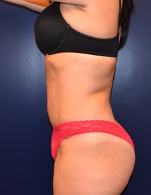 Tummy Tuck After Photo by Richard Reish, MD, FACS; New York, NY - Case 30814