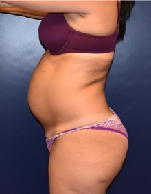 Tummy Tuck Before Photo by Richard Reish, MD, FACS; New York, NY - Case 30814