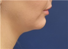 Chin Augmentation Before Photo by Richard Reish, MD, FACS; New York, NY - Case 30836