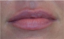 Lip Augmentation/Enhancement After Photo by Richard Reish, MD, FACS; New York, NY - Case 30940