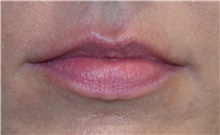 Lip Augmentation/Enhancement Before Photo by Richard Reish, MD, FACS; New York, NY - Case 30940