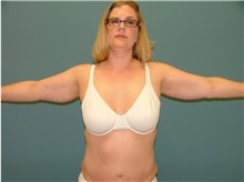 Arm Lift After Photo by Arturo Guiloff, MD; Palm Beach Gardens, FL - Case 31149