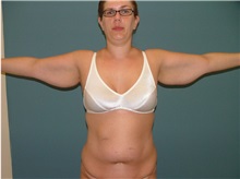 Arm Lift Before Photo by Arturo Guiloff, MD; Palm Beach Gardens, FL - Case 31149