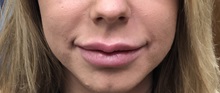 Lip Augmentation/Enhancement After Photo by Jason Petrungaro, MD, FACS; Munster, IN - Case 31359