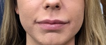 Lip Augmentation/Enhancement Before Photo by Jason Petrungaro, MD, FACS; Munster, IN - Case 31359