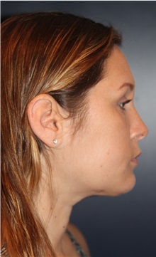 Liposuction After Photo by Larry Weinstein, MD; Chester, NJ - Case 31893