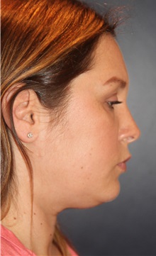 Liposuction Before Photo by Larry Weinstein, MD; Chester, NJ - Case 31893