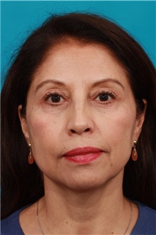 Eyelid Surgery After Photo by Michael Bogdan, MD, MBA, FACS; Grapevine, TX - Case 32240