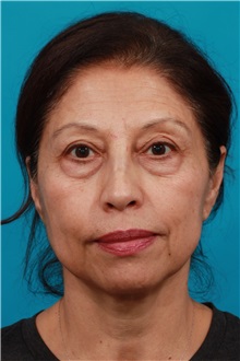 Eyelid Surgery Before Photo by Michael Bogdan, MD, MBA, FACS; Grapevine, TX - Case 32240