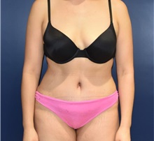 Tummy Tuck After Photo by Richard Reish, MD, FACS; New York, NY - Case 32662