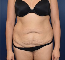 Tummy Tuck Before Photo by Richard Reish, MD, FACS; New York, NY - Case 32662