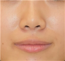 Rhinoplasty After Photo by Richard Reish, MD, FACS; New York, NY - Case 32684