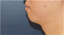 Chin Augmentation Before Photo by Richard Reish, MD, FACS; New York, NY - Case 32835