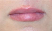 Lip Augmentation/Enhancement After Photo by Richard Reish, MD, FACS; New York, NY - Case 32885