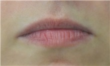 Lip Augmentation/Enhancement Before Photo by Richard Reish, MD, FACS; New York, NY - Case 32885