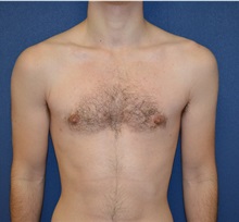 Male Breast Reduction After Photo by Matthew Kilgo, MD, FACS; Garden City, NY - Case 33214