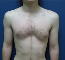 Male Breast Reduction Before Photo by Matthew Kilgo, MD, FACS; Garden City, NY - Case 33214