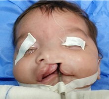 Cleft Lip and Palate Repair Before Photo by Tarek Elbanoby, MD; Cairo,  - Case 33580