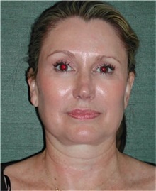 Facelift Before Photo by Steven Wallach, MD; New York, NY - Case 33640