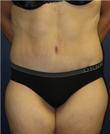Body Lift After Photo by Matthew Kilgo, MD, FACS; Garden City, NY - Case 33871