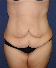 Body Lift Before Photo by Matthew Kilgo, MD, FACS; Garden City, NY - Case 33871