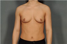 Breast Reduction After Photo by Ellen Janetzke, MD; Bloomfield Hills, MI - Case 33901