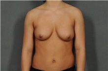 Breast Reduction Before Photo by Ellen Janetzke, MD; Bloomfield Hills, MI - Case 33901