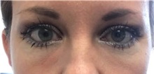 Dermal Fillers After Photo by Babis Rammos, MD, FACS; Peoria, IL - Case 33968