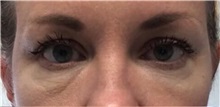 Dermal Fillers Before Photo by Babis Rammos, MD, FACS; Peoria, IL - Case 33968